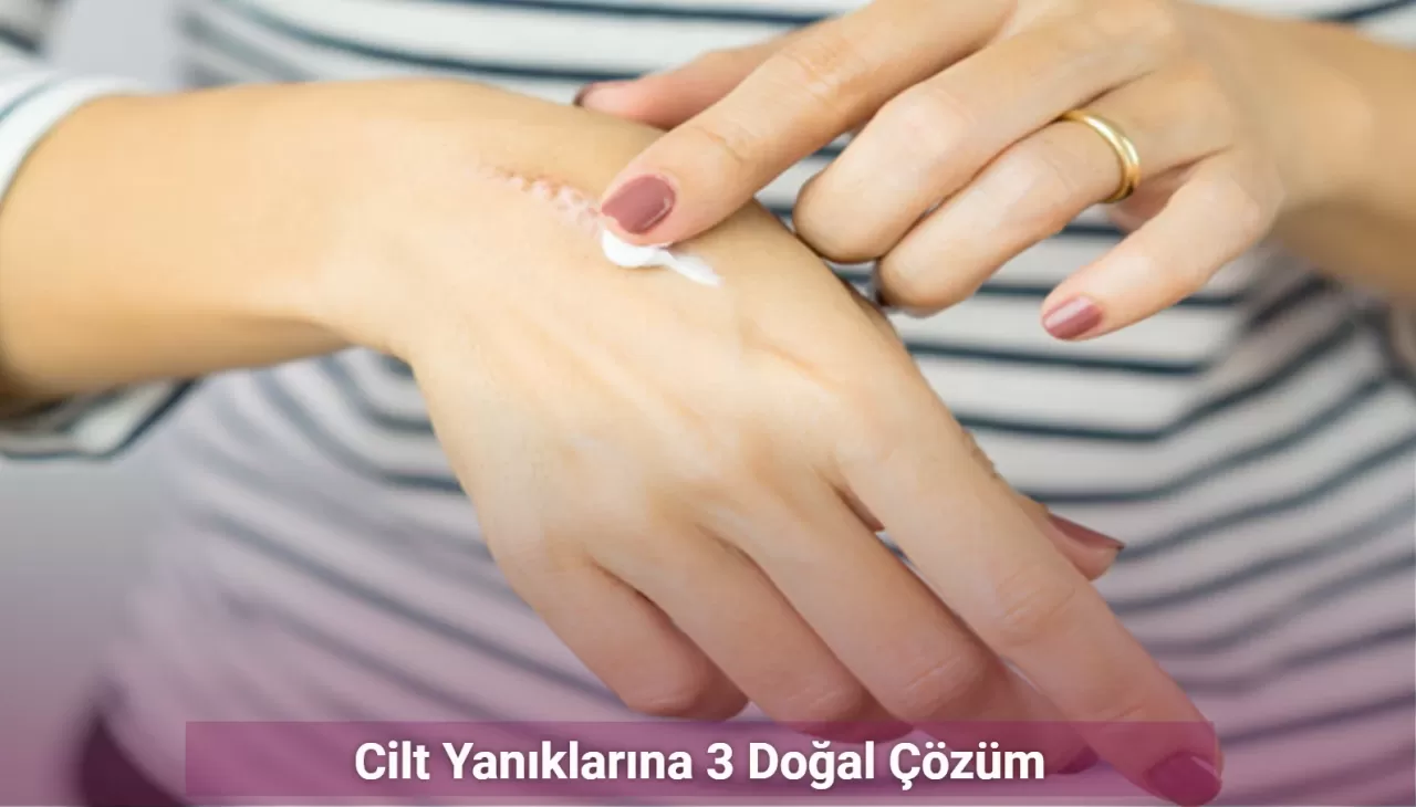 Cilt Yanıklarına 3 Doğal Çözüm