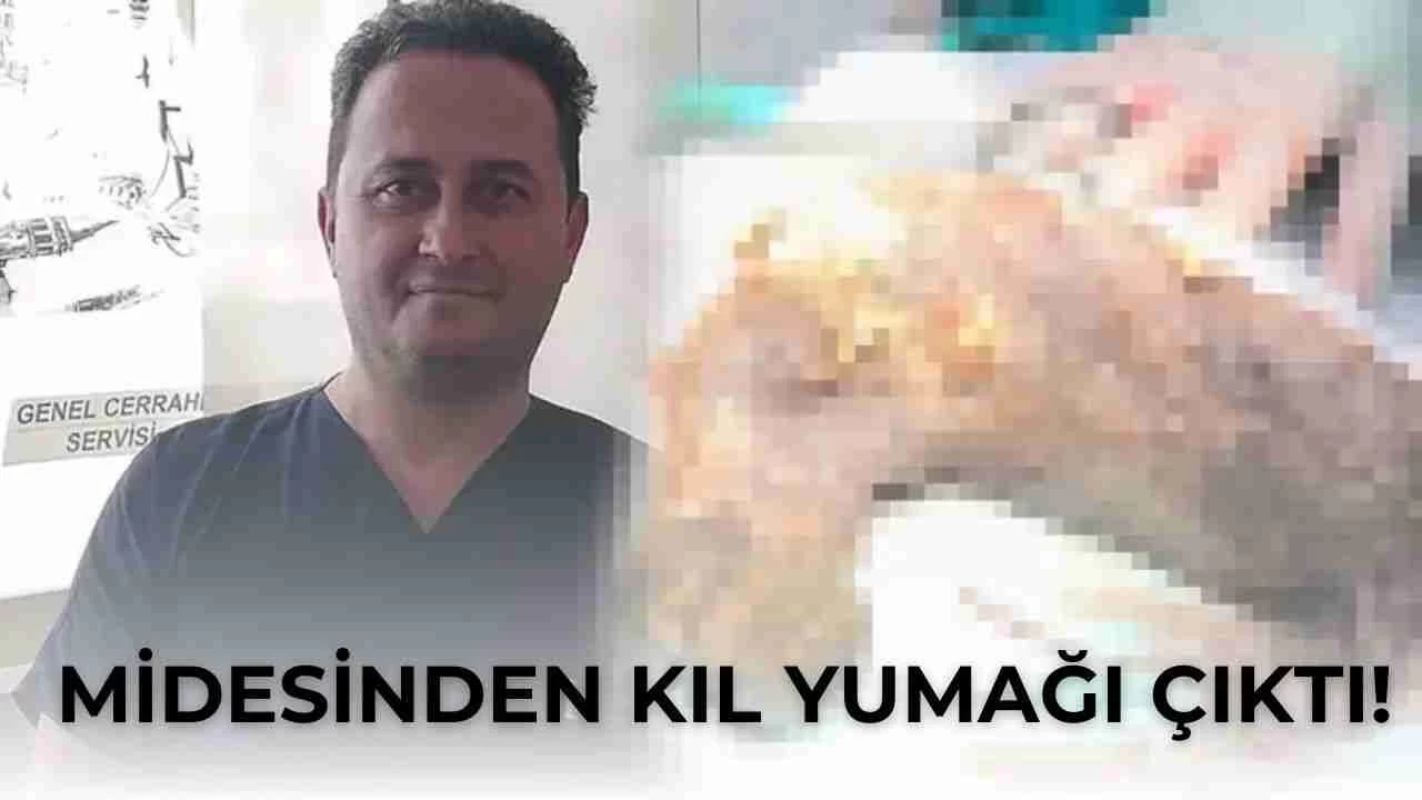 Midesinden Kıl Yumağı Çıktı! Doktorlar Gördüğüne İnanamadı!