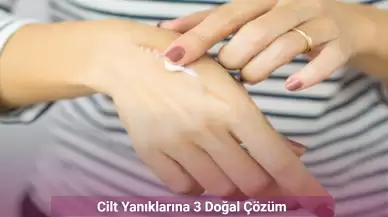 Cilt Yanıklarına 3 Doğal Çözüm