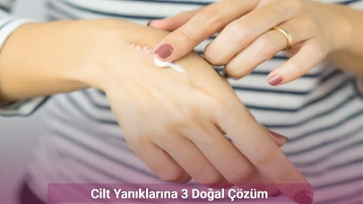 Cilt Yanıklarına 3 Doğal Çözüm